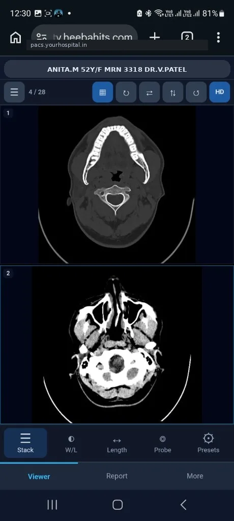 HEEBA mobile viewer 2-up multi-pane layout (demo patient Anita M)