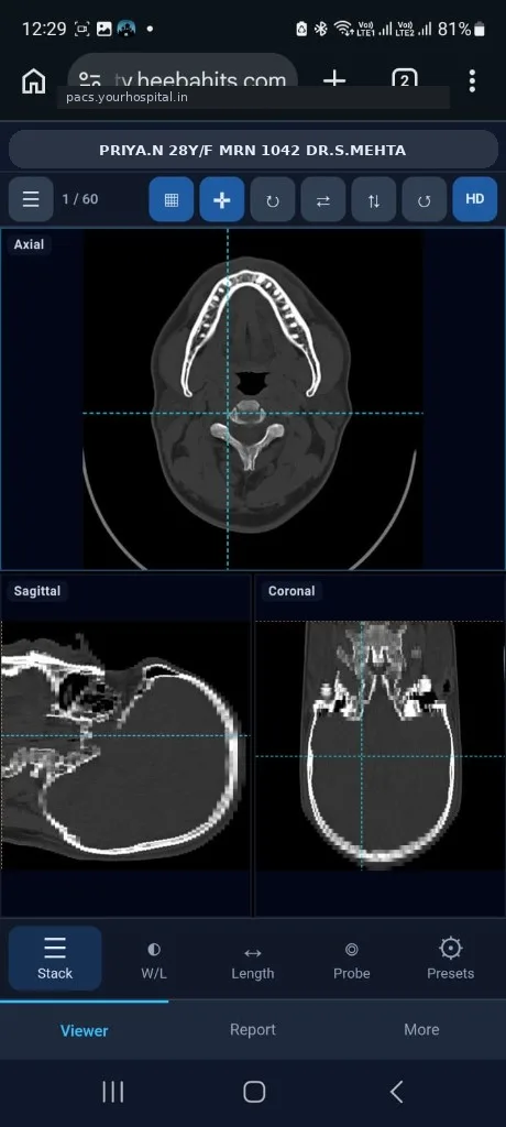 HEEBA mobile viewer MPR — axial, sagittal and coronal (demo patient Priya N)